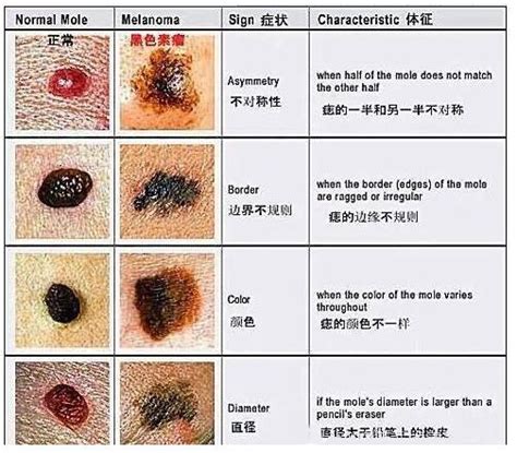 腰部長痣|【腰有痣】腰有痣的秘密：揭開富貴長壽的關鍵